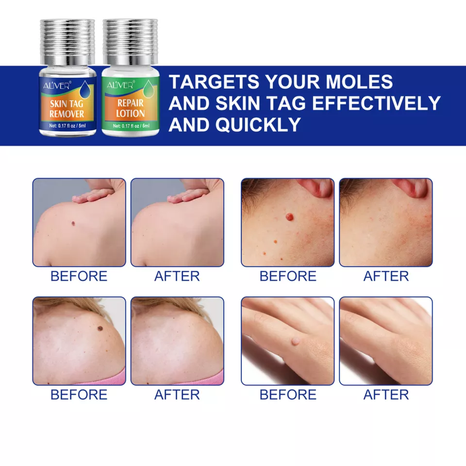 ALIVER 2in1 Effective Body Skin Tag Mole & Wart Removal Kit