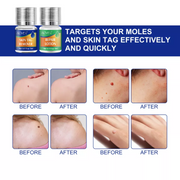ALIVER 2in1 Effective Body Skin Tag Mole & Wart Removal Kit