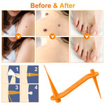 ALIVER Orange Skin Tag Remover Kit