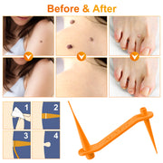 ALIVER Orange Skin Tag Remover Kit
