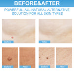 ELAIMEI 2in1 Skin Tag Remover & Repair Lotion