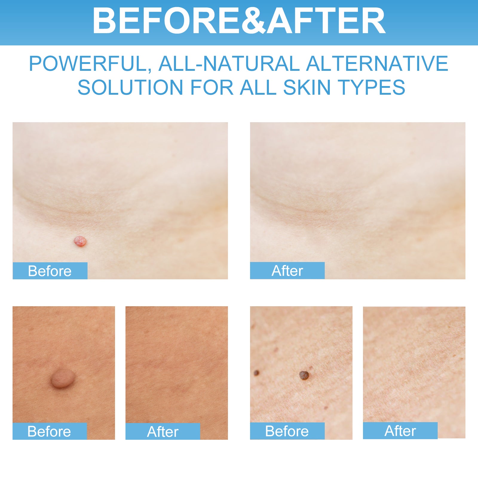 ELAIMEI 2in1 Skin Tag Remover & Repair Lotion