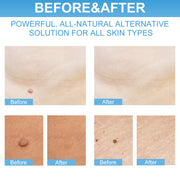 ELAIMEI 2in1 Skin Tag Remover & Repair Lotion