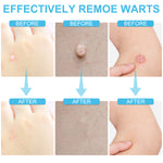 ELAIMEI Skin Tag Remover, Wart & Mole Body Liquid, 30ml