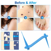 ALIVER 2in1 Blue Skin Tag Removal Kit