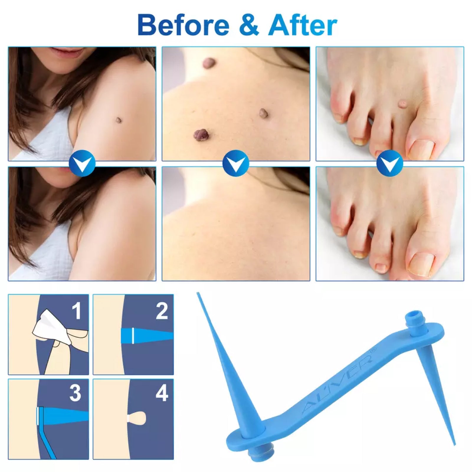 ALIVER 2in1 Blue Skin Tag Removal Kit
