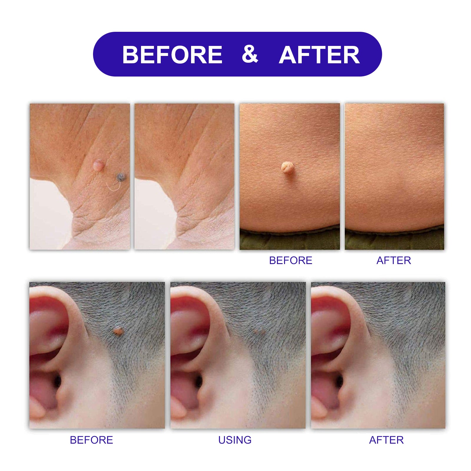 ALIVER Safe Skin Tag Remover Patches, pack of 180pcs