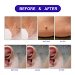 ALIVER Safe Skin Tag Remover Patches, pack of 180pcs