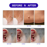 ALIVER Safe Skin Tag Remover Patches, pack of 180pcs