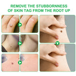 ALIVER Body Skin Tag & Wart Remover Ointment, 20g