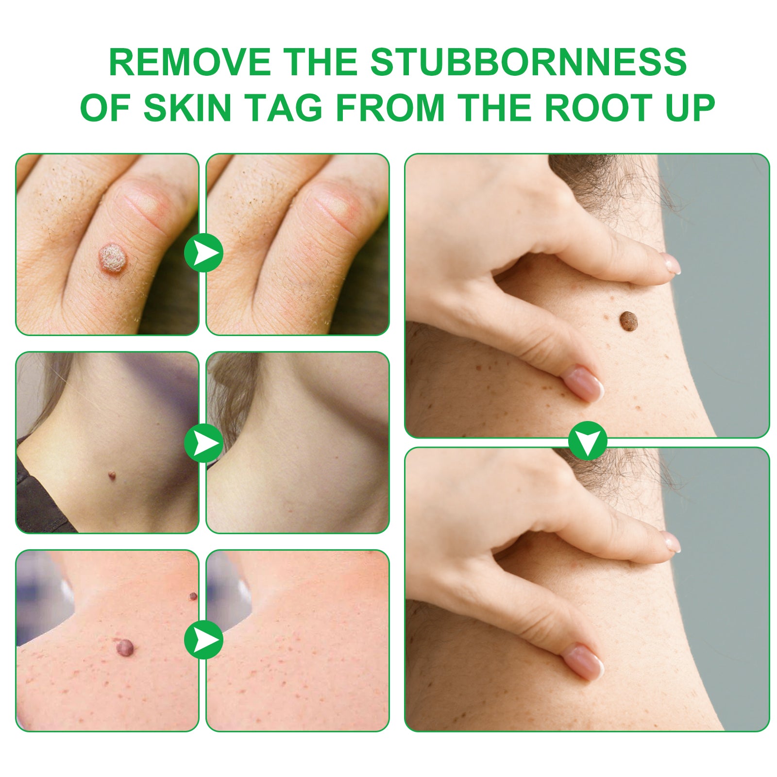 ALIVER Body Skin Tag & Wart Remover Ointment, 20g