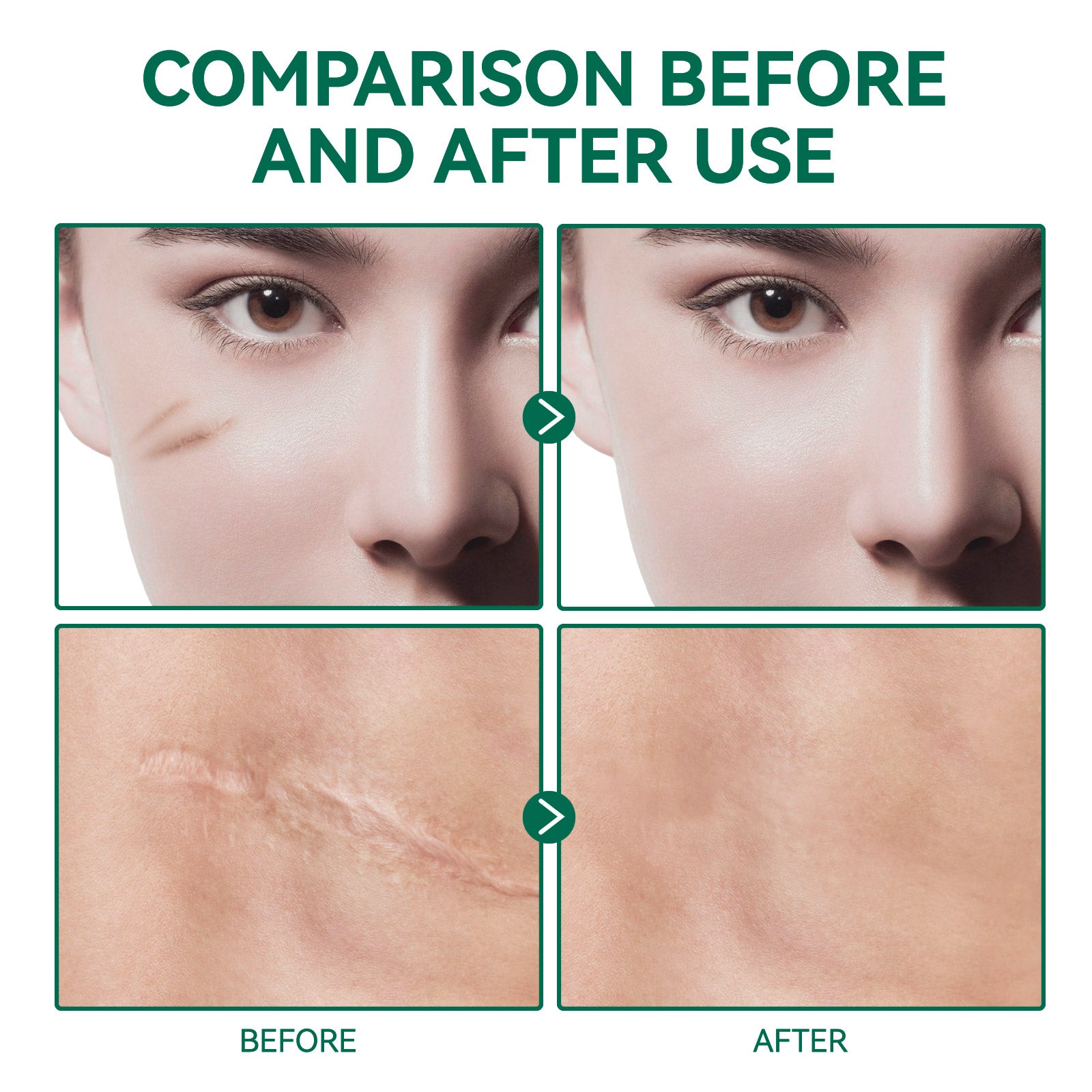 ELAIMEI Advanced Scar Removal Gel for Body, 50ml