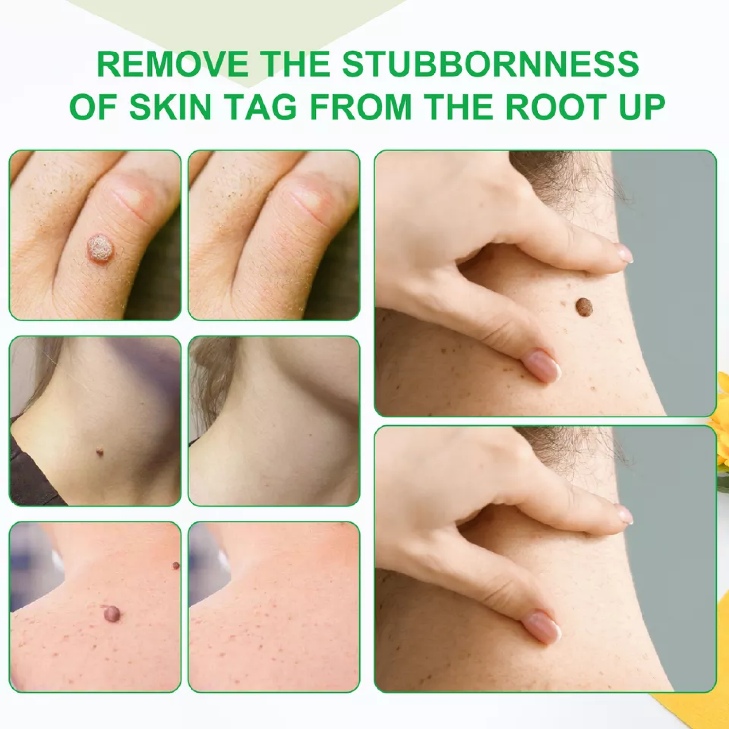 ALIVER Skin Tag, Acne & Wart Remover Cream, 100g