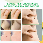 ALIVER Skin Tag, Acne & Wart Remover Cream, 100g