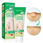 SEFUDUN Lipoma Removal Cream, 20g