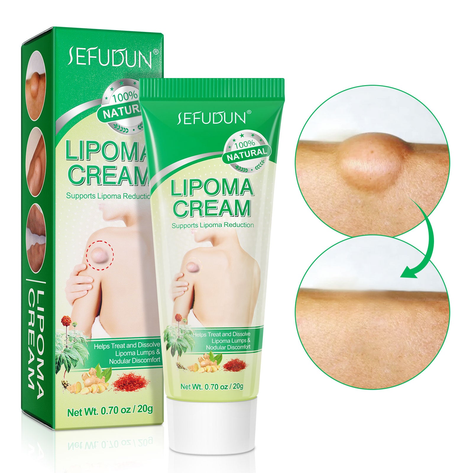 SEFUDUN Lipoma Removal Cream, 20g