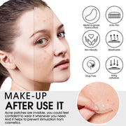 ELAIMEI Acne Pimple Patches for Face, 20pcs