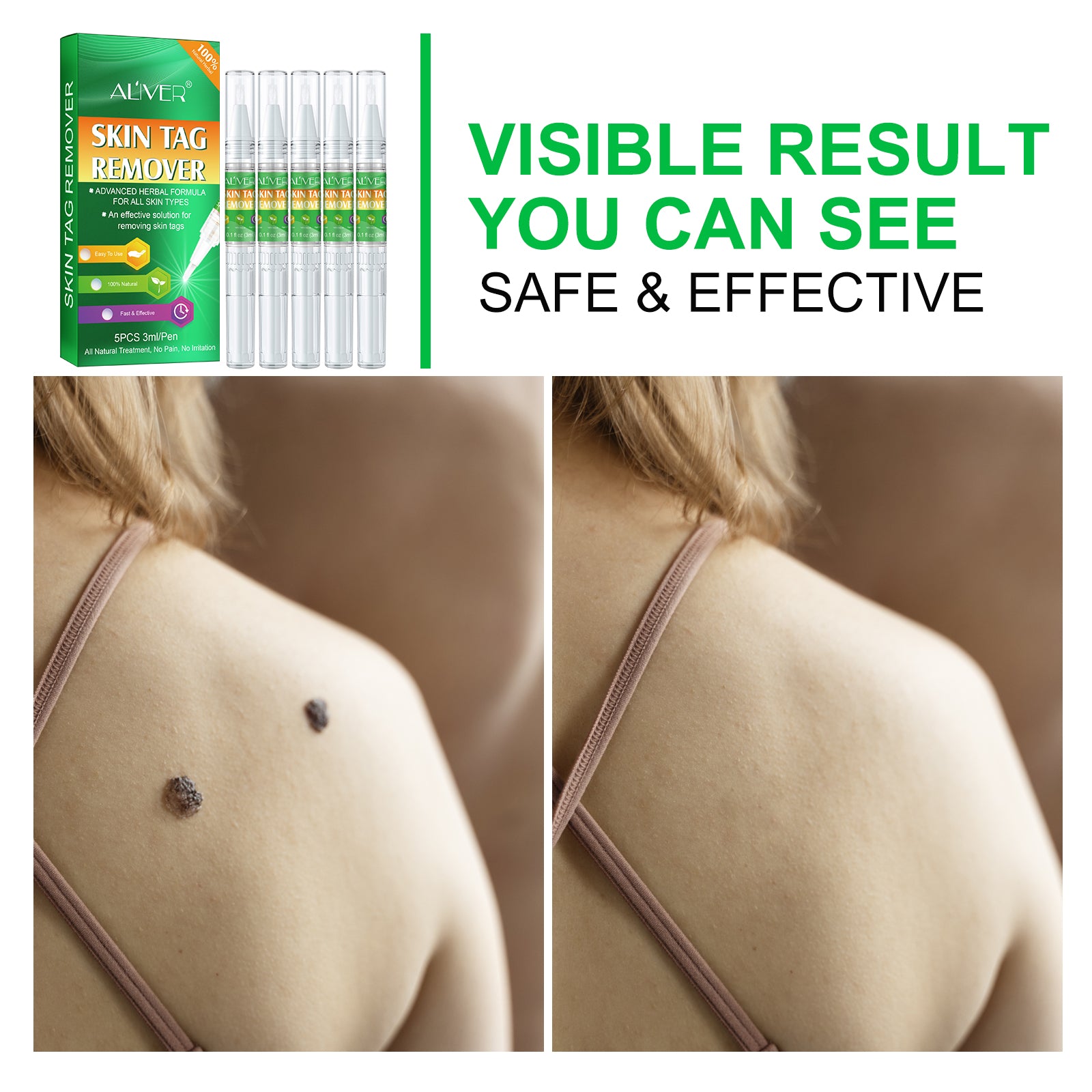 ALIVER Body Skin Tag Remover Pens, Anti Mole & Wart Kit, 5pcs