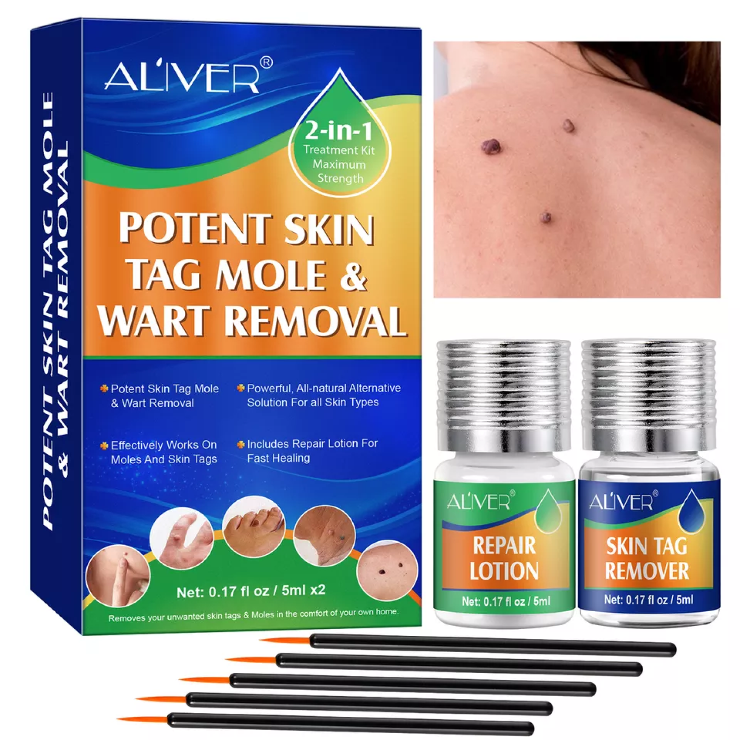 ALIVER 2in1 Effective Body Skin Tag Mole & Wart Removal Kit