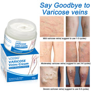 VOGSIG Varicose Veins Cream, 50g