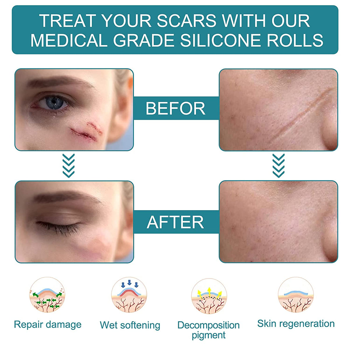 Elaimei Silicone Gel Sheet Roll for Scar Removal Treatment Tape 1.5M