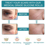 Elaimei Silicone Gel Sheet Roll for Scar Removal Treatment Tape 1.5M