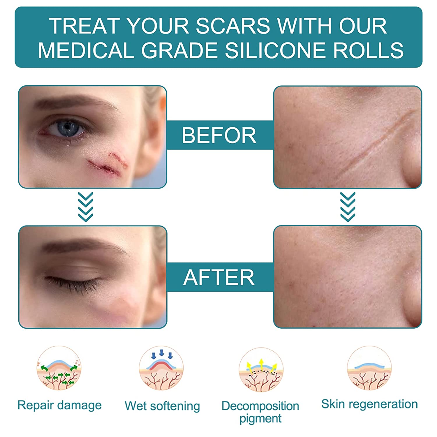 Elaimei Silicone Gel Sheet Roll for Scar Removal Treatment Tape 1.5M