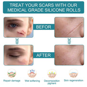 Elaimei Silicone Gel Sheet Roll for Scar Removal Treatment Tape 1.5M