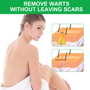 ALIVER Skin Tag, Acne & Wart Remover Cream, 100g