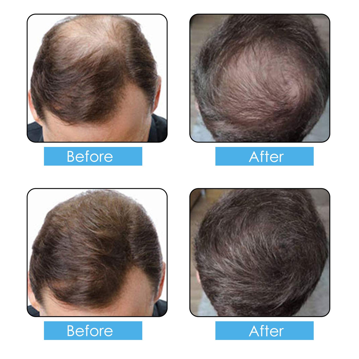 ELAIMEI Hair Building Fibers Alopecia Keratin Thicker Concealer Hair Loss Powder for Men & Women, Dark Brown Bag 50g