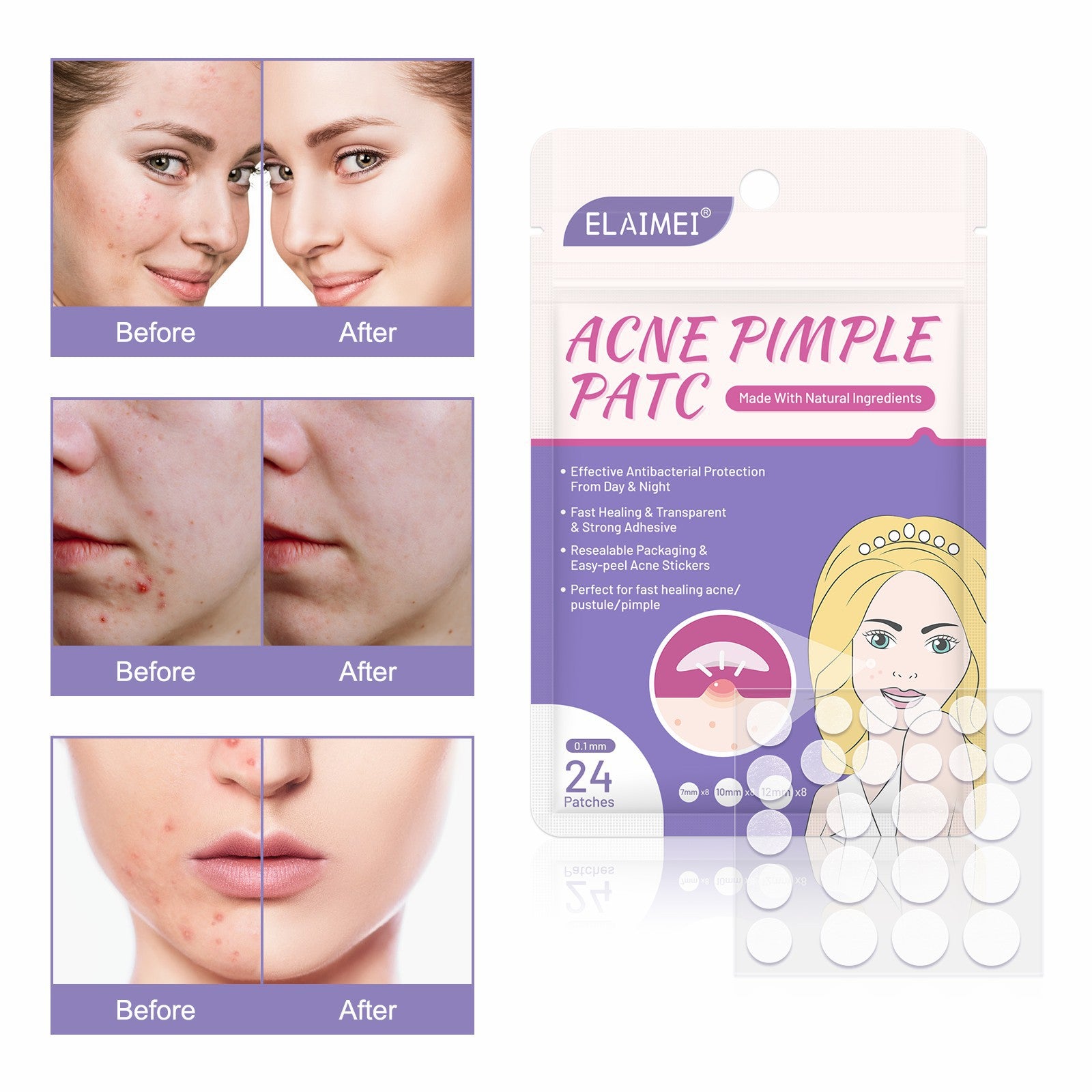 Elaimei Removal Acne Pimple Patches Plasters Face Skin Dot Stickers Cover Treatment Hydrocolloid Spot Blemishes Comedone Remover Cleaner (24 pcs )
