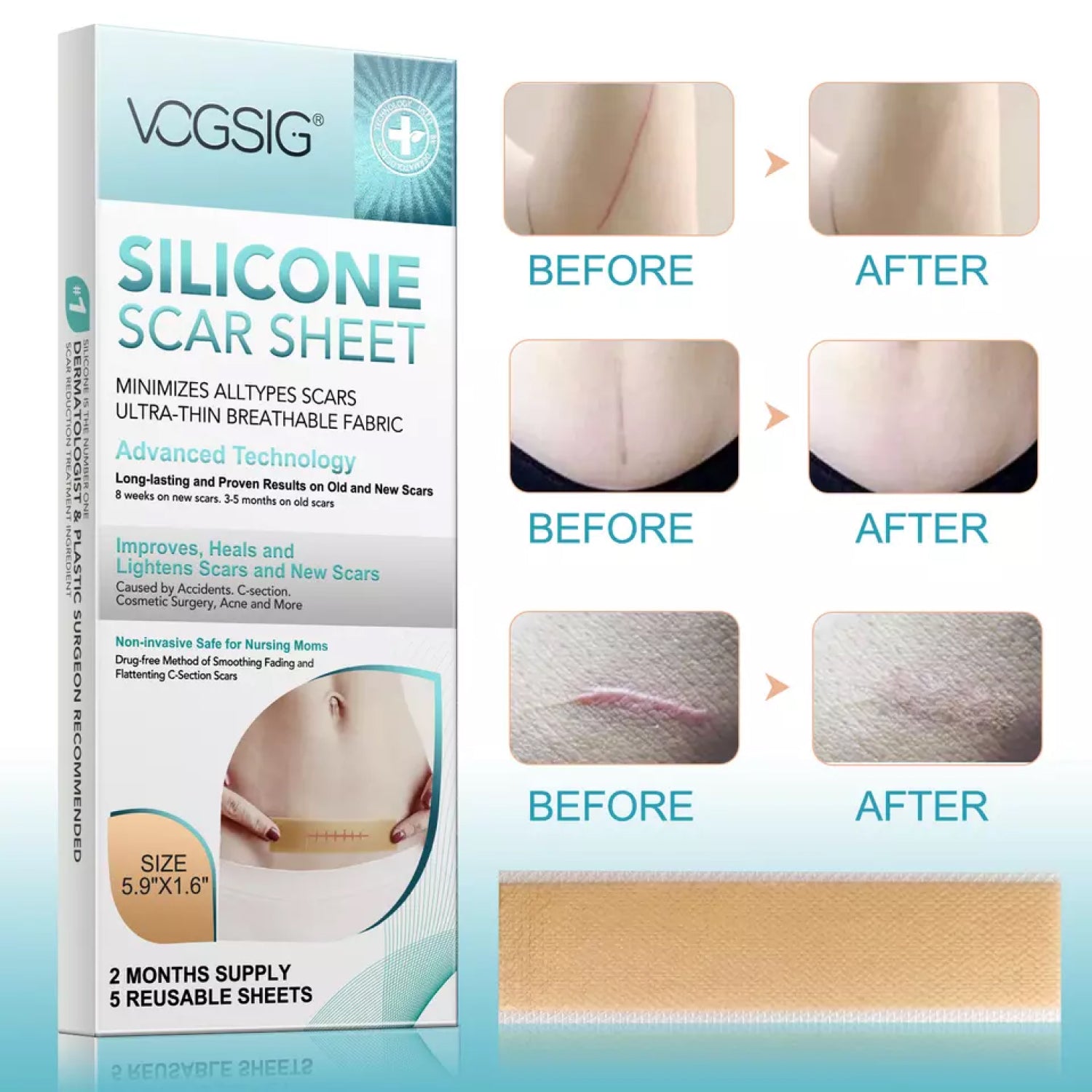 VOGSIG Silicone Scar Sheets, pack of 5 pcs