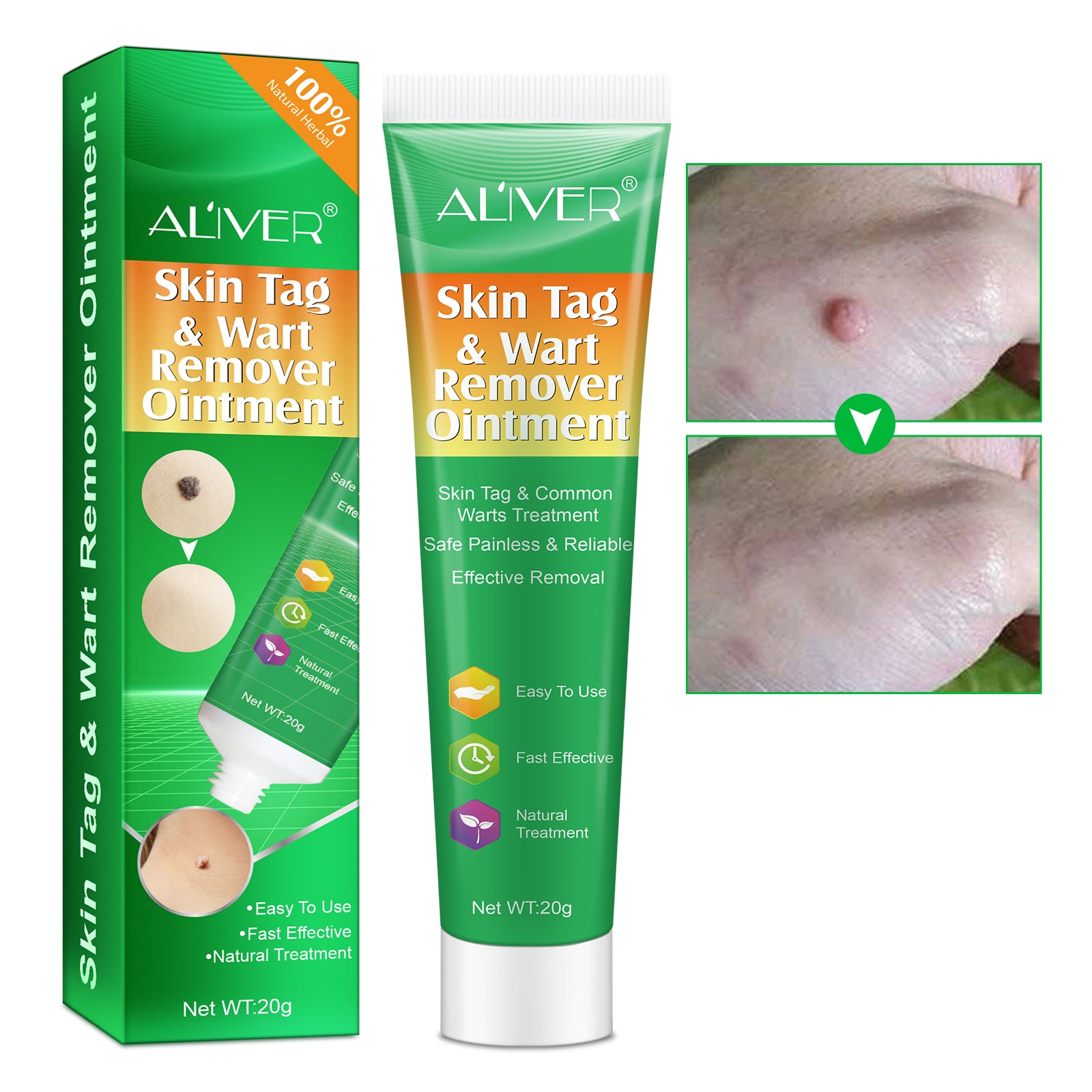 ALIVER Body Skin Tag & Wart Remover Ointment, 20g