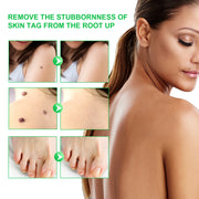 ALIVER Body Skin Tag Remover Pens, Anti Mole & Wart Kit, 5pcs