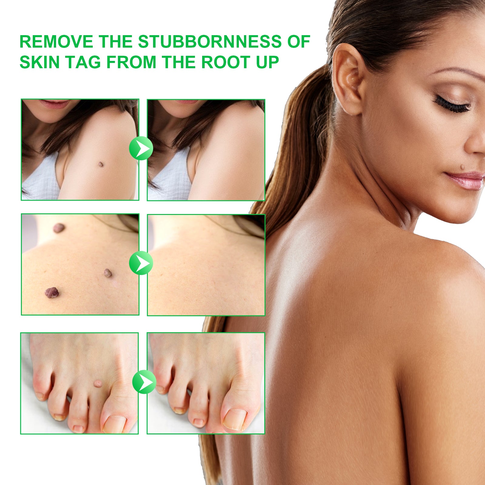 ALIVER Body Skin Tag Remover Pens, Anti Mole & Wart Kit, 5pcs