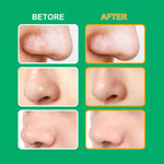 ELAIMEI T-Zone Hydrocolloid Nose Patches
