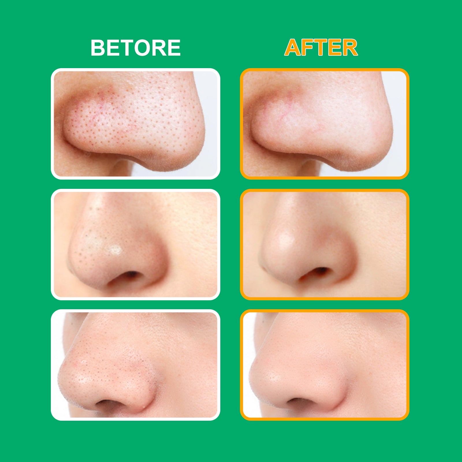 ELAIMEI T-Zone Hydrocolloid Nose Patches