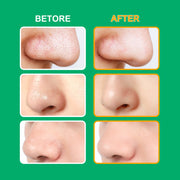 ELAIMEI T-Zone Hydrocolloid Nose Patches