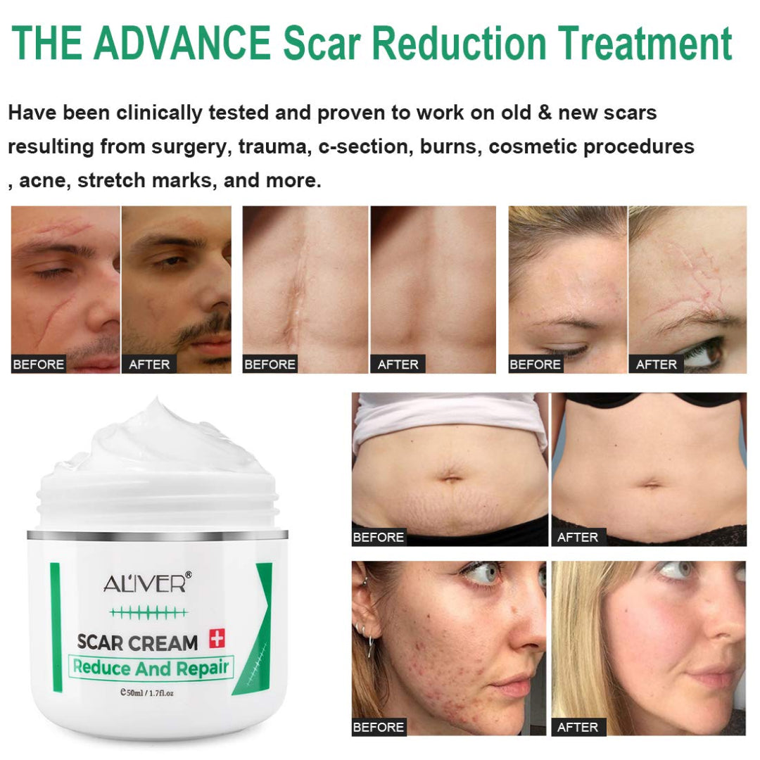 Aliver Treatment Scar Remove Cream for Body Face Skin
