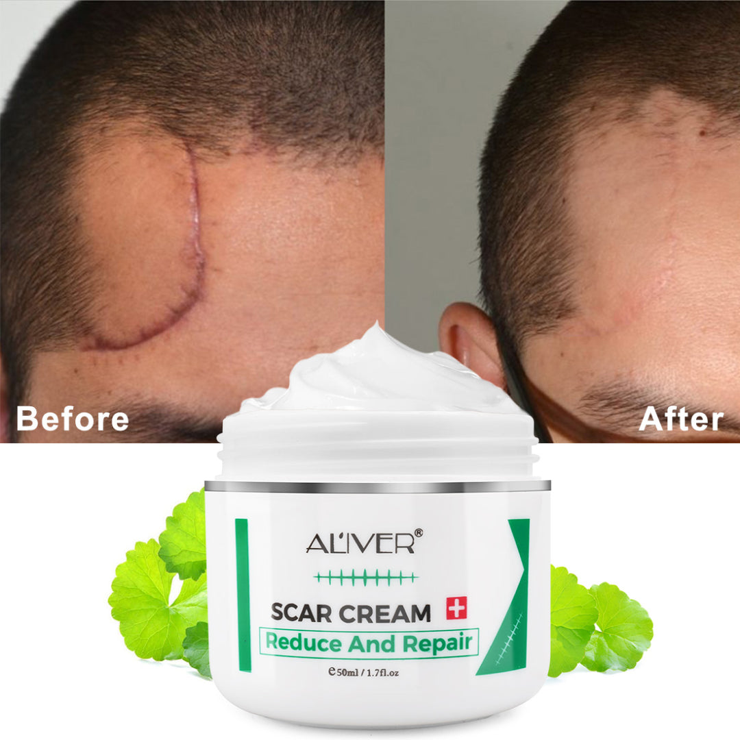 Aliver Treatment Scar Remove Cream for Body Face Skin