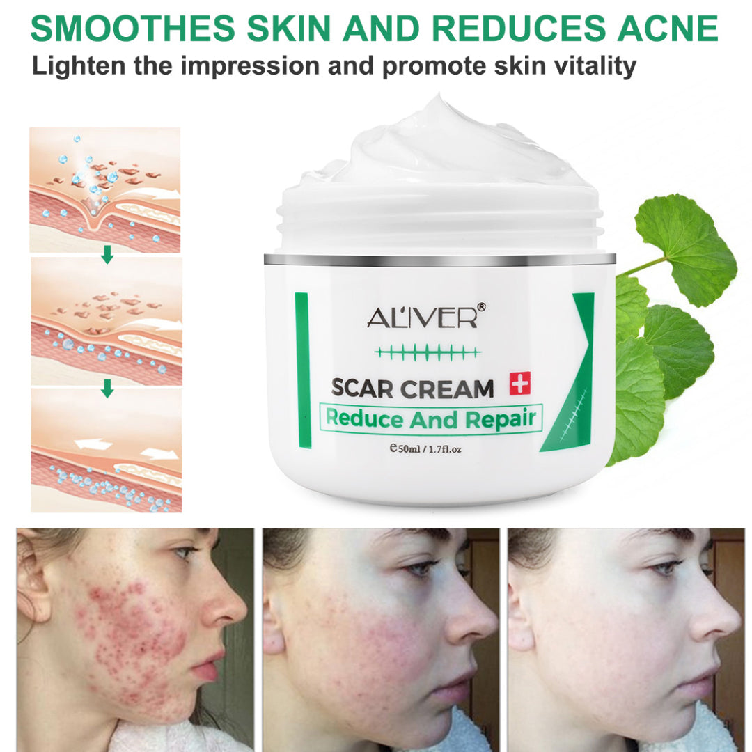 Aliver Treatment Scar Remove Cream for Body Face Skin