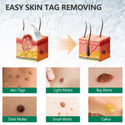 ELAIMEI Natural Herbal Skin Tag Remover Cream, 100g