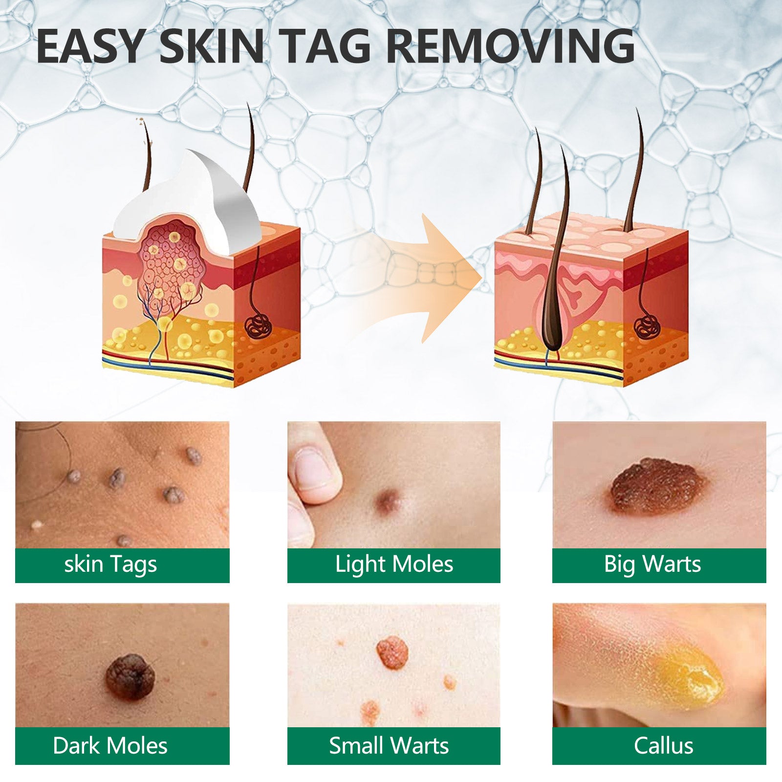 ELAIMEI Natural Herbal Skin Tag Remover Cream, 100g