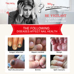Aliver Fungus Nail Anti Fungal Infection Oil Treatment