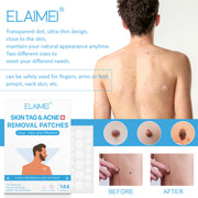 ELAIMEI Patches for Skin Tag & Acne Removal, 144pcs