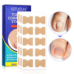 SEFUDUN Toenail Correction Stickers, pack of 100pcs