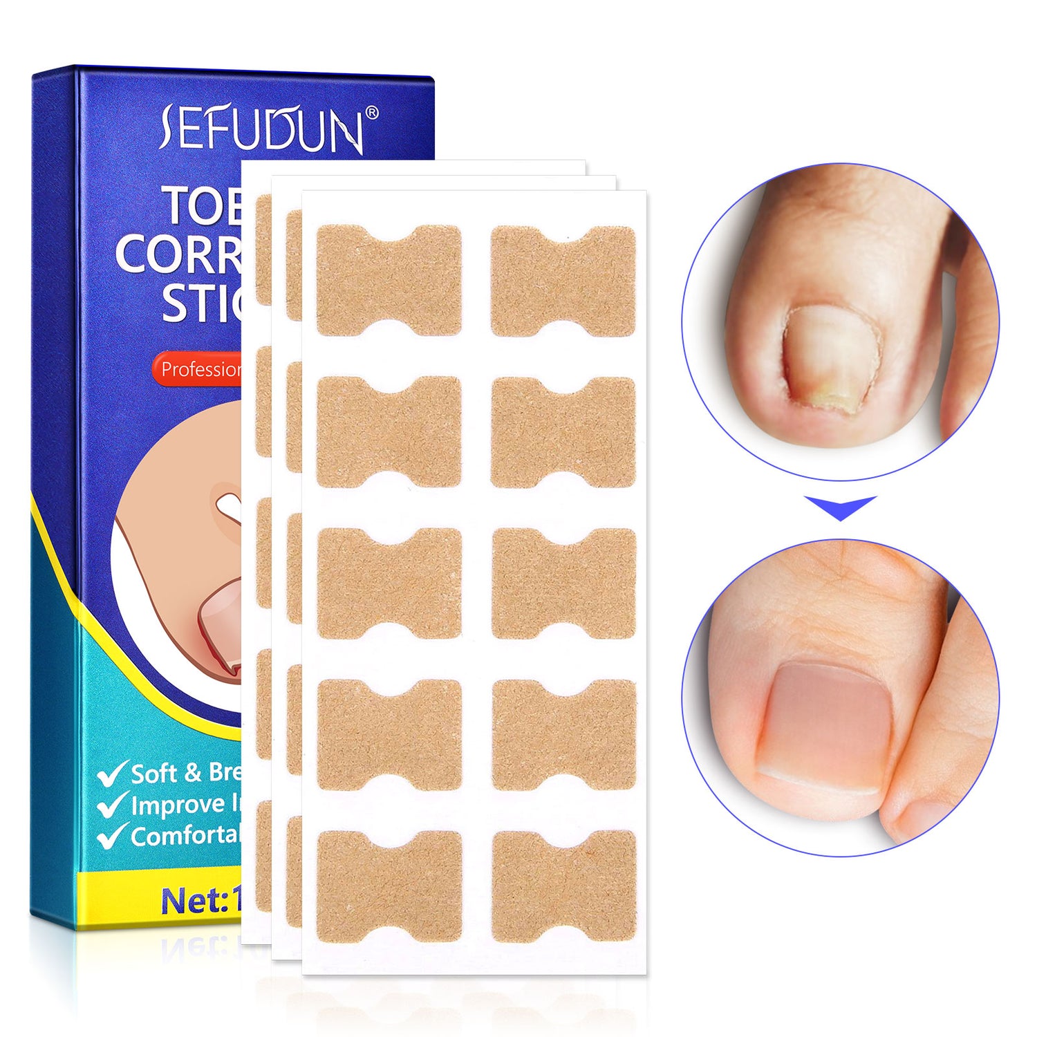 SEFUDUN Toenail Correction Stickers, pack of 100pcs
