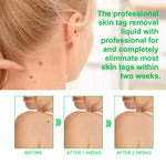 ALIVER Body Skin Tag Remover Pens, Anti Mole & Wart Kit, 5pcs