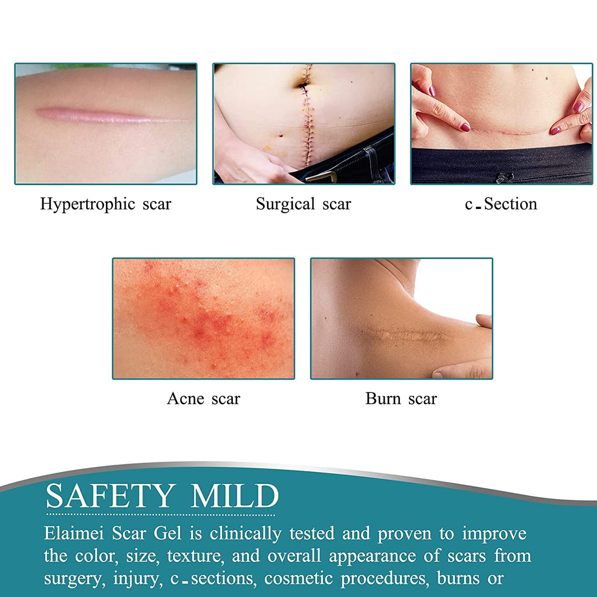 Elaimei Silicone Gel Sheet Roll for Scar Removal Treatment Tape 1.5M