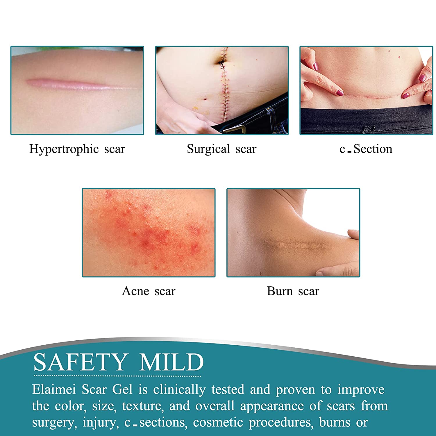 Elaimei Silicone Gel Sheet Roll for Scar Removal Treatment Tape 1.5M